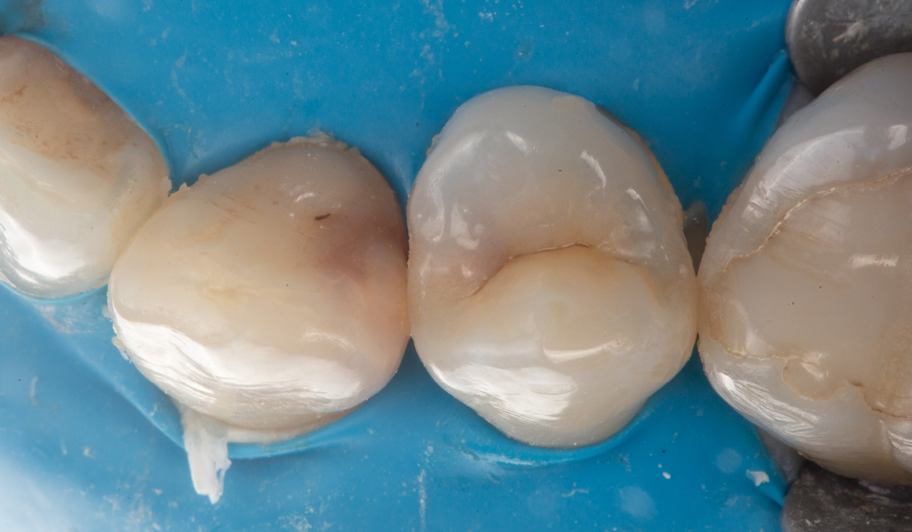 Fig. 1: Preoperative view under rubber dam isolation